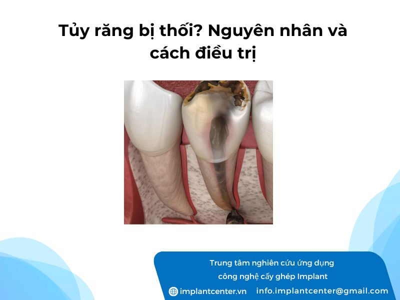 Tuy-rang-bi-thoi-Nguyen-nhan-va-cach-dieu-tri